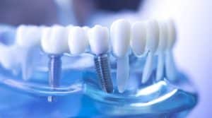 Dental Implants in Hickory, NC