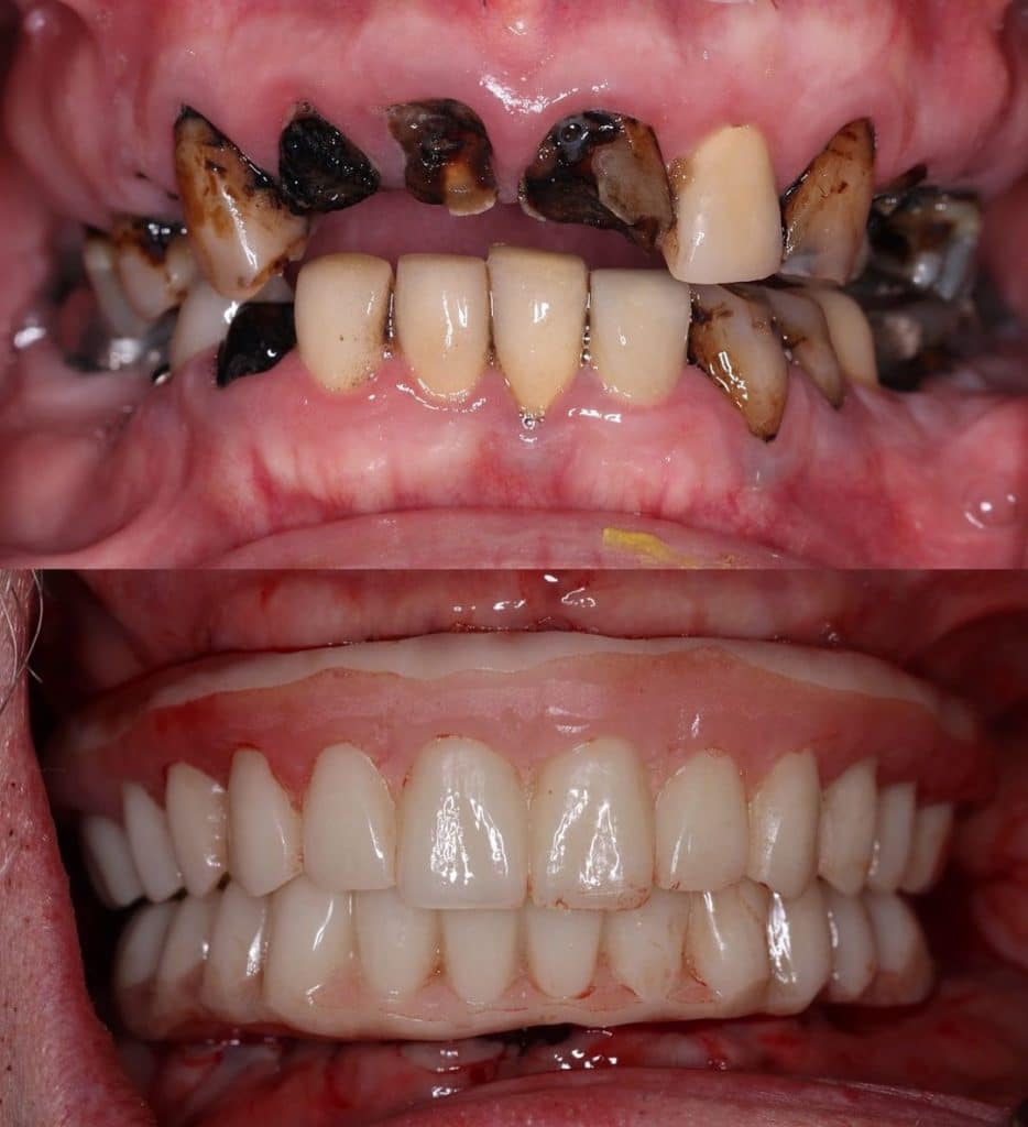 Teeth in a Day Dental Implants Before and After Pictures McKinney-Graham Dental Arts Hickory Implant Dentist