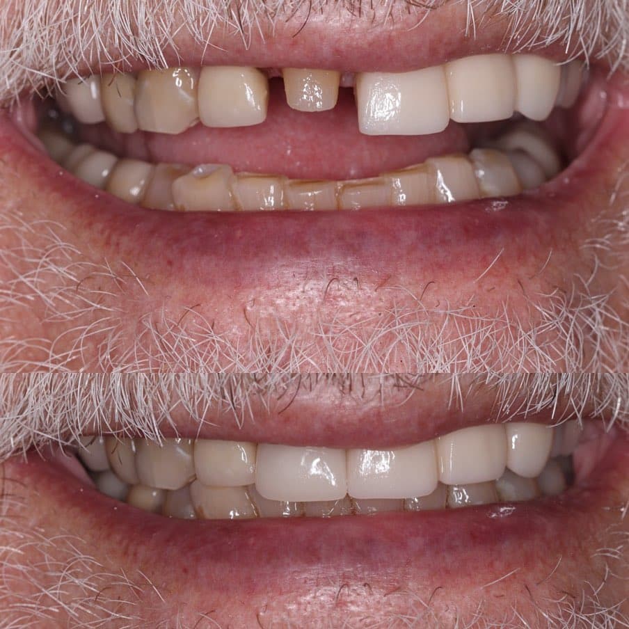 Same day fixes are the best! Patient had broken and old crown off day before his anniversary! He jokingly said he couldn’t have his wife look at him without a tooth the next day. 