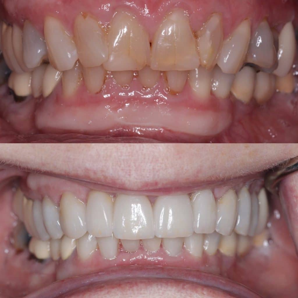A dramatic before and after using veneers for this patient!