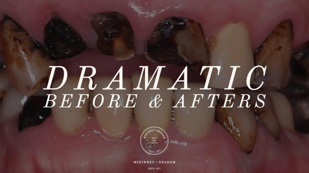 Dramatic Before and Afters at McKinney-Graham Dental Arts Hickory NC