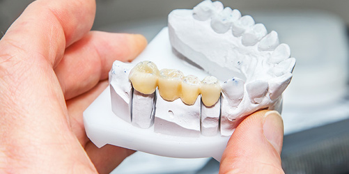 Maryland bonded dental bridge model with metal wings and plastic teeth for front tooth replacement.