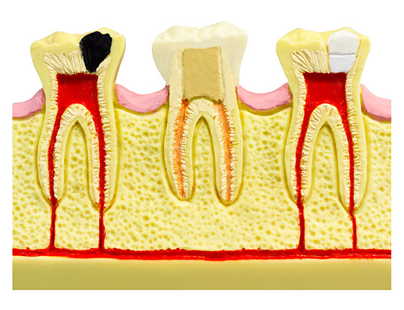 Tooth anatomy model demonstrating infection and stages of root canal therapy.