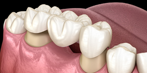 Traditional dental bridge with crowns and pontic replacing a missing tooth.