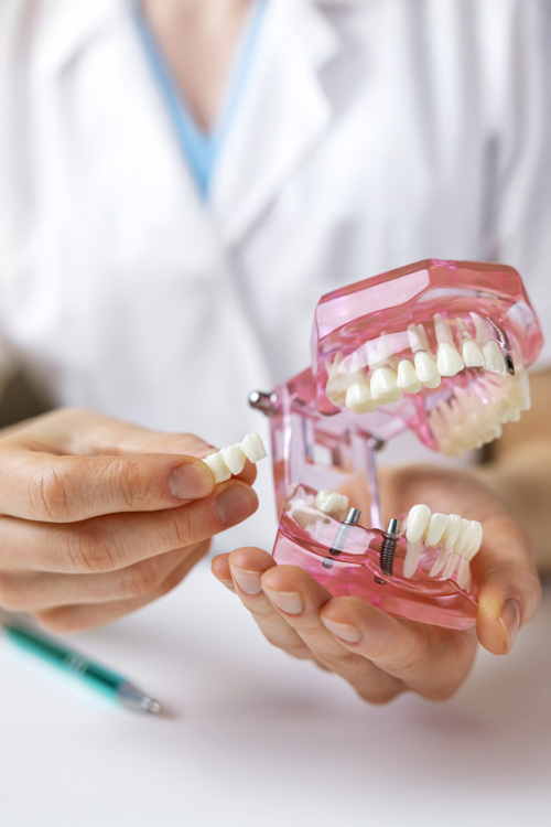 Dentist demonstrating how dental bridges fit onto existing teeth