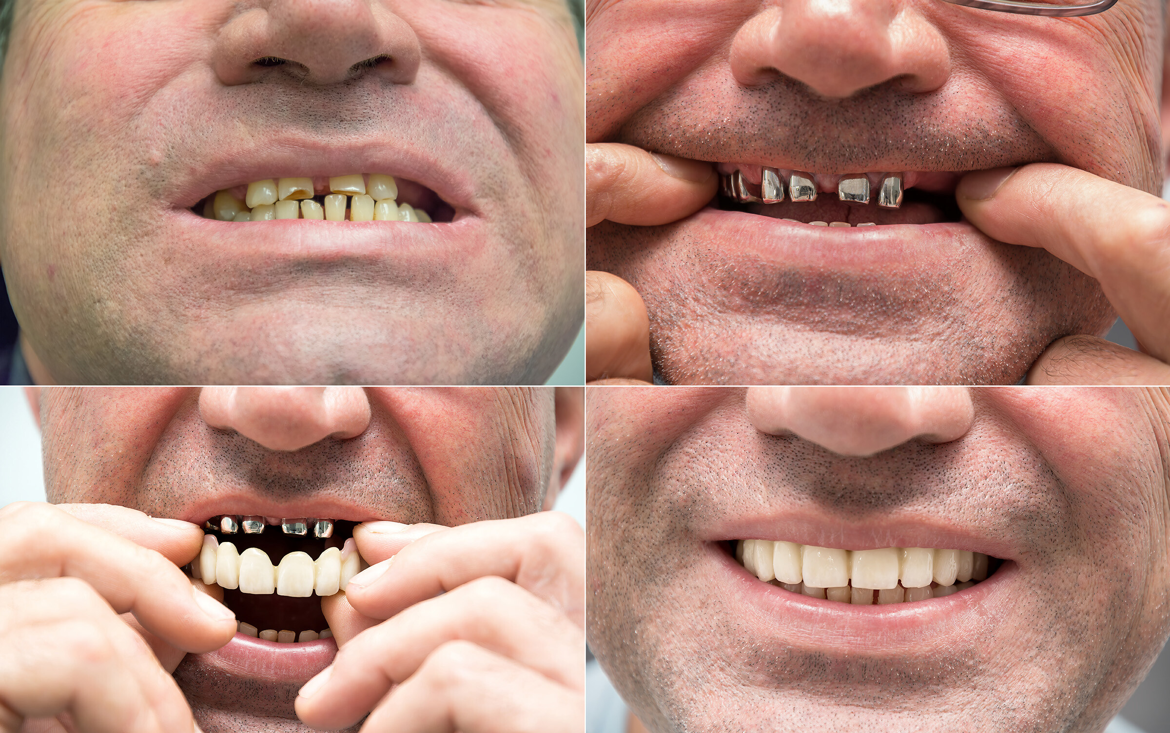 Before and after smile results from dental bridge treatment
