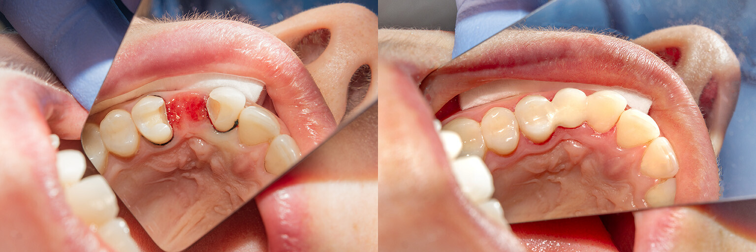 Before and after dental bridge procedure showing improved tooth appearance