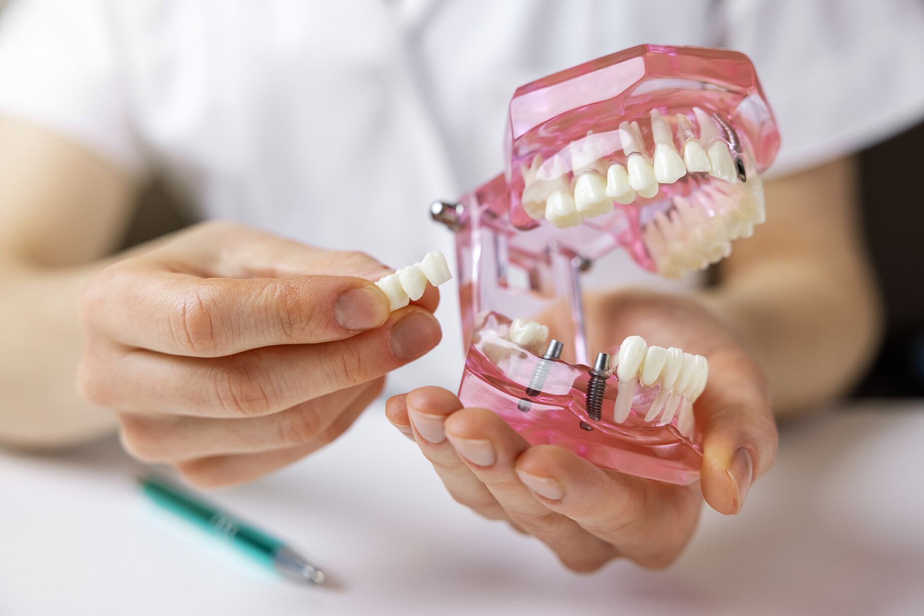 Close-up of a dental bridge model showing how replacement teeth are supported