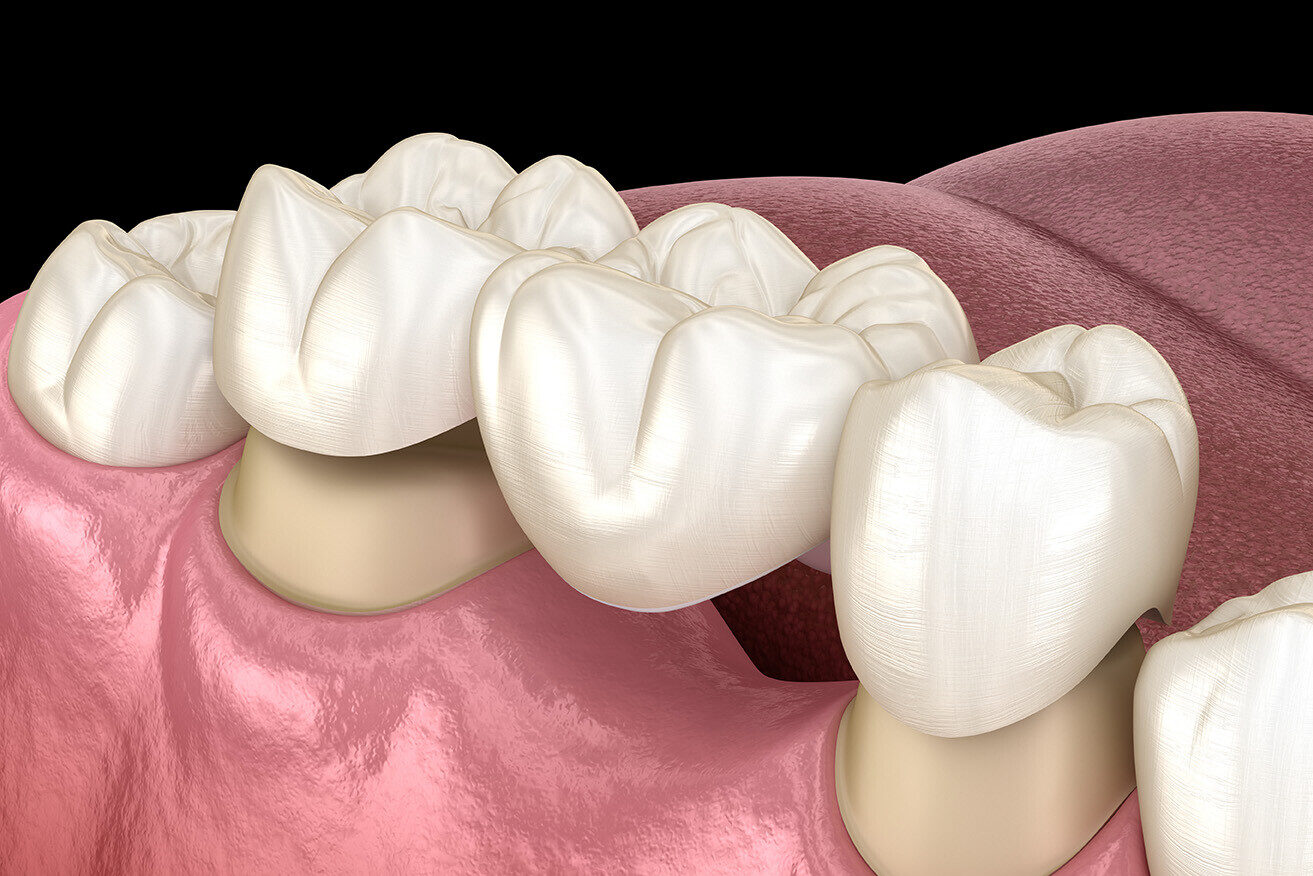 Illustration of a traditional dental bridge showing crowns supporting a replacement tooth