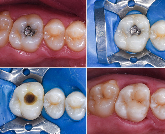Dental fillings and restorations before and after photos of molar repair