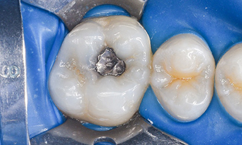 Amalgam fillings and restorations applied to a molar during a dental filling restoration procedure