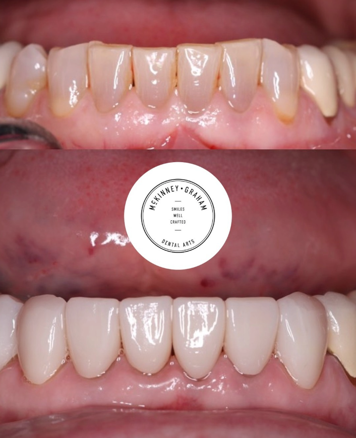 Before-and-after comparison showing teeth improved with dental veneers