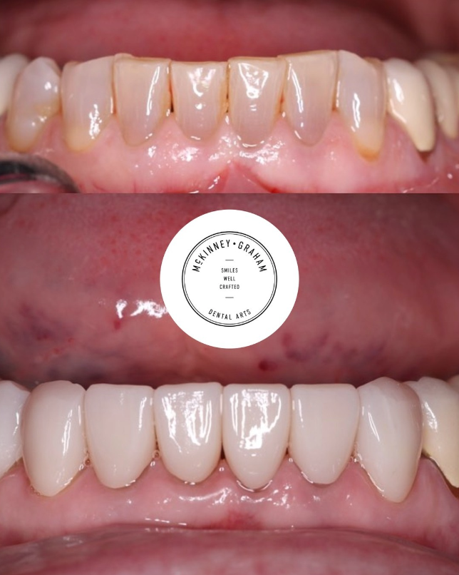 Before-and-after comparison of worn teeth improved with dental veneers