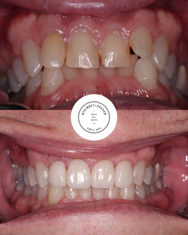 Before-and-after smile improvement using dental veneers