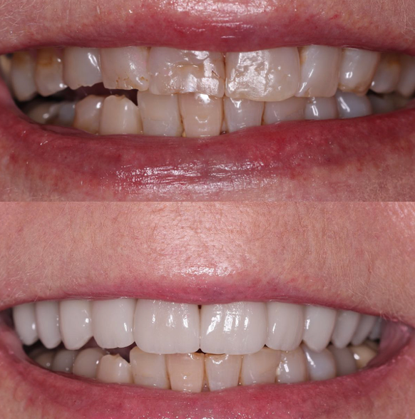 Before-and-after images showing teeth reshaped and brightened with dental veneers