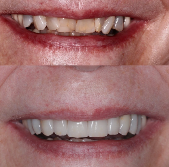 Before-and-after images showing teeth reshaped and brightened with dental veneers
