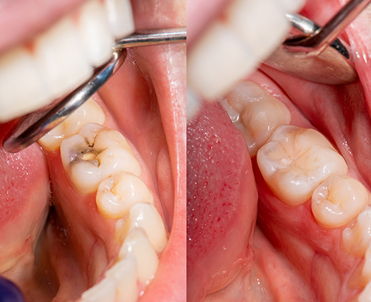 Before and after dental fillings and restorations showing cavity removal and tooth restoration