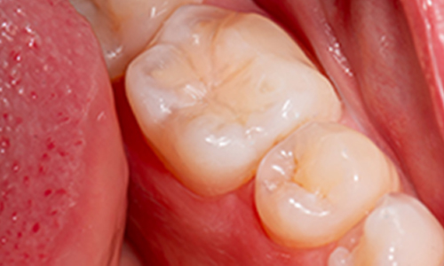 Composite dental fillings and restorations placed on a molar for natural-looking tooth restoration
