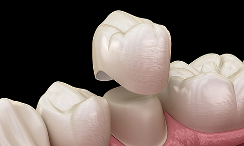Dental crown restoration model showing a custom-made tooth cap