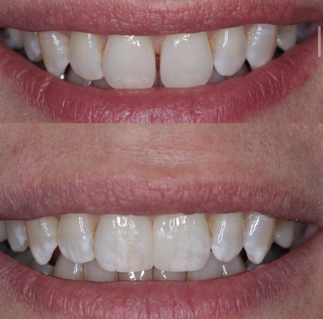 Before-and-after photos of a patient’s smile improved with dental bonding treatment