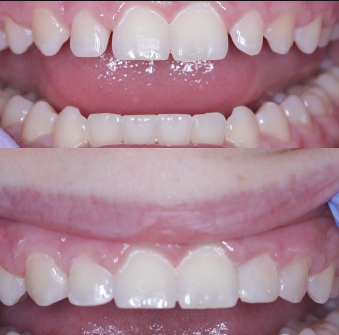 Close-up before-and-after images showing reshaped and restored teeth with bonding