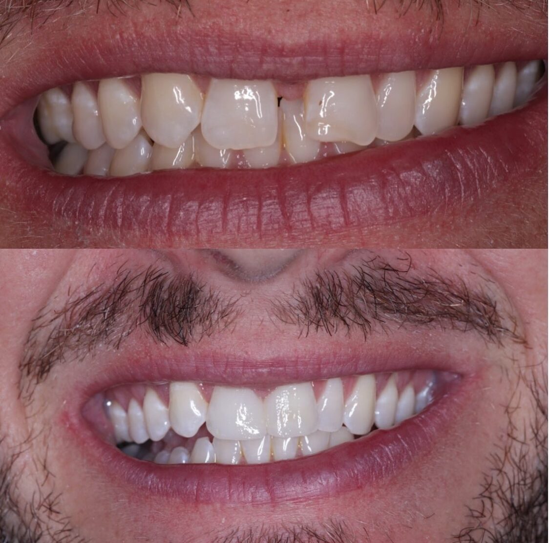 Before-and-after smile enhancement achieved using dental bonding