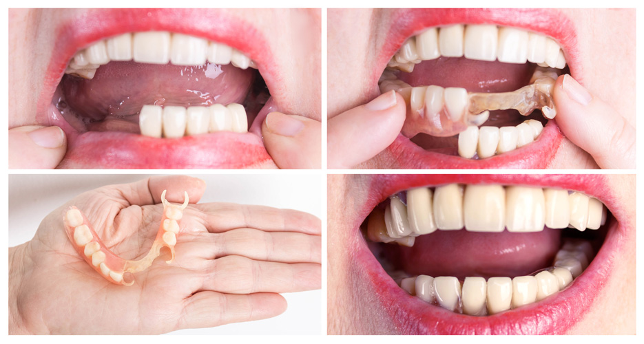 Before and after dentures showing missing teeth restored with natural-looking replacement teeth