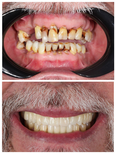 Dentures before and after results showing badly decayed teeth replaced with a full, healthy smile