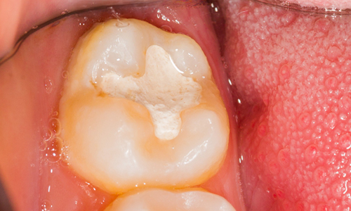Glass ionomer dental fillings and restorations on a back tooth used for long-lasting restoration
