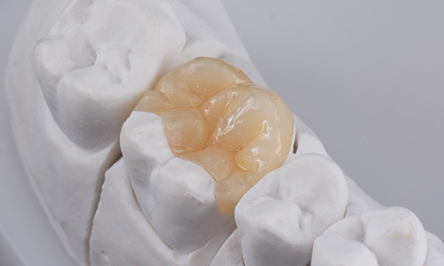 Tooth receiving an inlay restoration for repairing decay on chewing surfaces