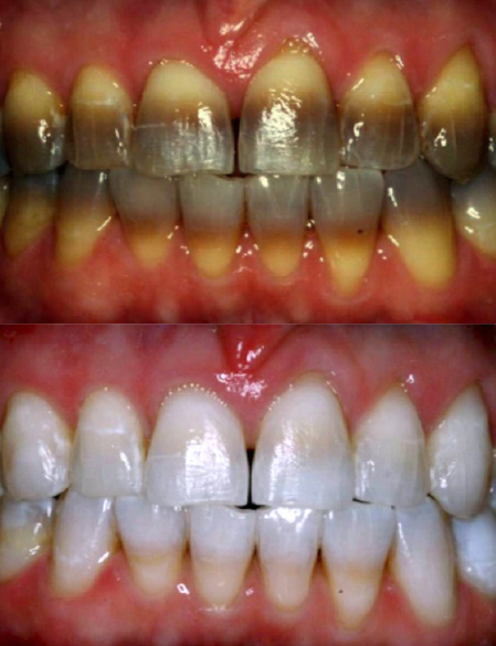 Teeth whitening transformation from severe staining to a noticeably brighter smile