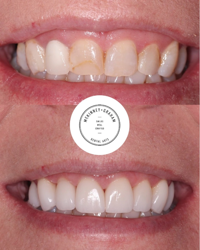 Before-and-after photos showing stained and chipped teeth restored with dental veneers