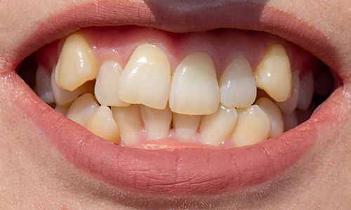 Crowded teeth needing removal for orthodontic treatment