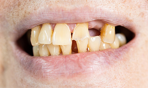 Advanced gum disease leading to tooth extractions