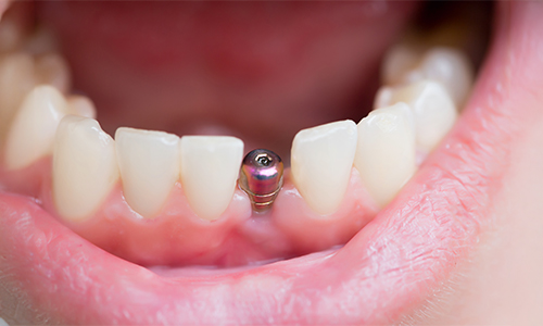 Extraction site prepared for dental implant placement