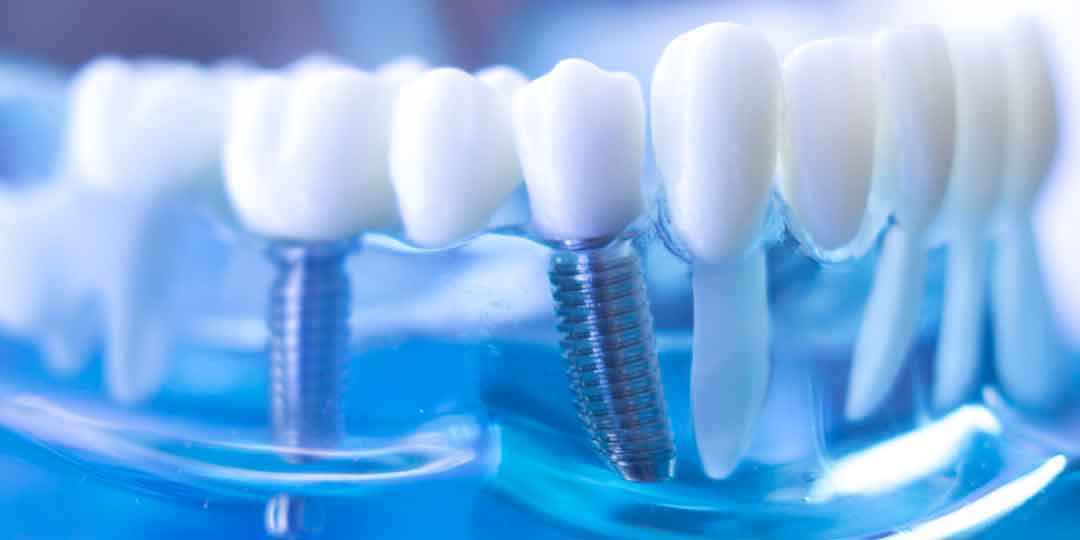 Close-up of dental implant posts showing titanium anchors for tooth replacement