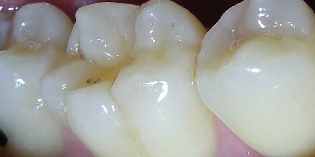 Close-up of molars showing protective dental sealants applied to tooth grooves