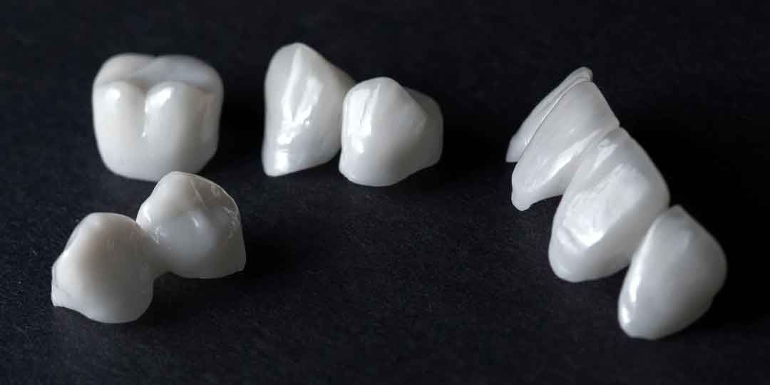 Dental bridge prosthetics used to replace missing teeth