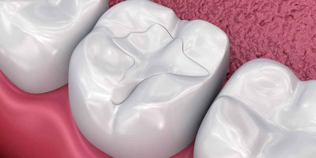 Dental models showing teeth prepared for fillings and restorative treatment