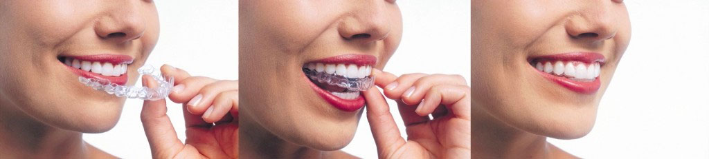 Three-step image showing a patient placing Invisalign aligners onto their teeth