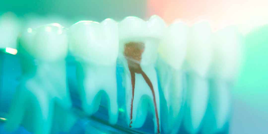 Illustration showing the inner structure of a tooth during a root canal