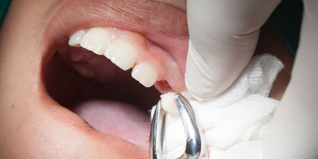 Dental professional performing a tooth extraction procedure