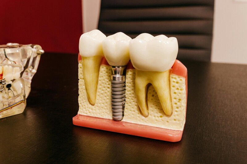 Dental implant model showing how implants replace missing teeth