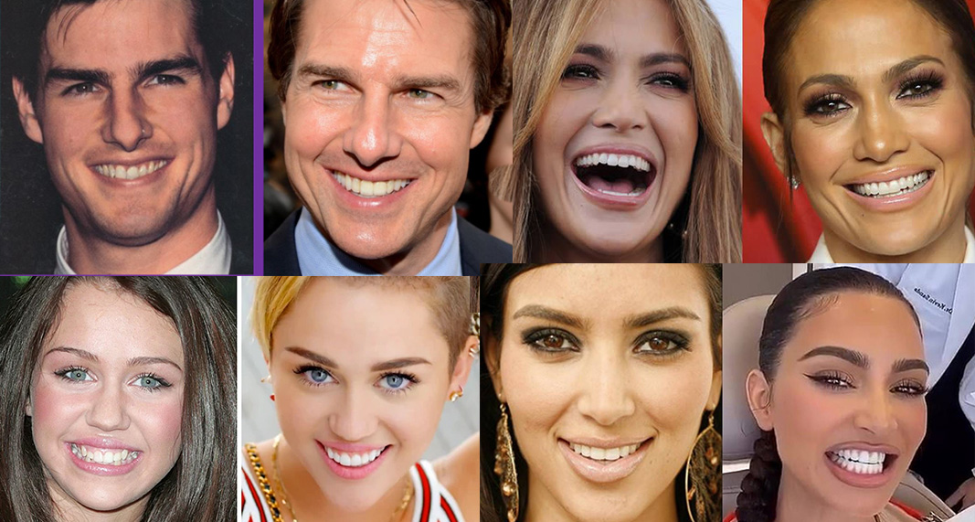 Featured image for “The A-List Smile: Celebrities Who Transformed Their Look with Cosmetic Dentistry”