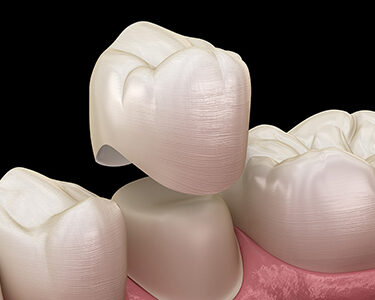 Restorative dentistry dental crown illustration showing tooth restoration