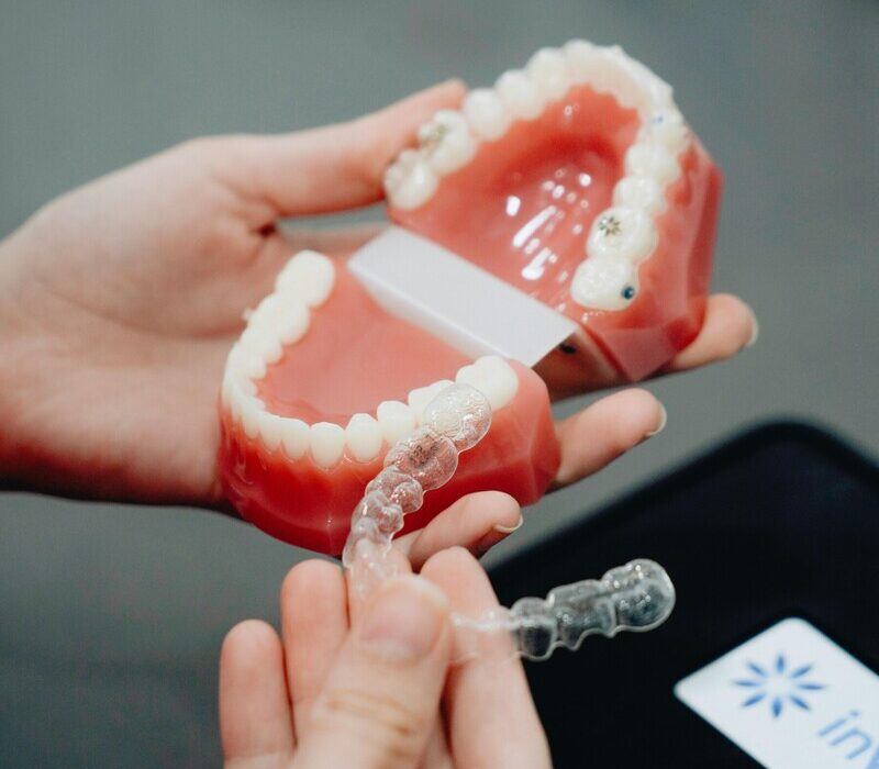 Invisalign clear aligners shown on dental model for adult orthodontic treatment