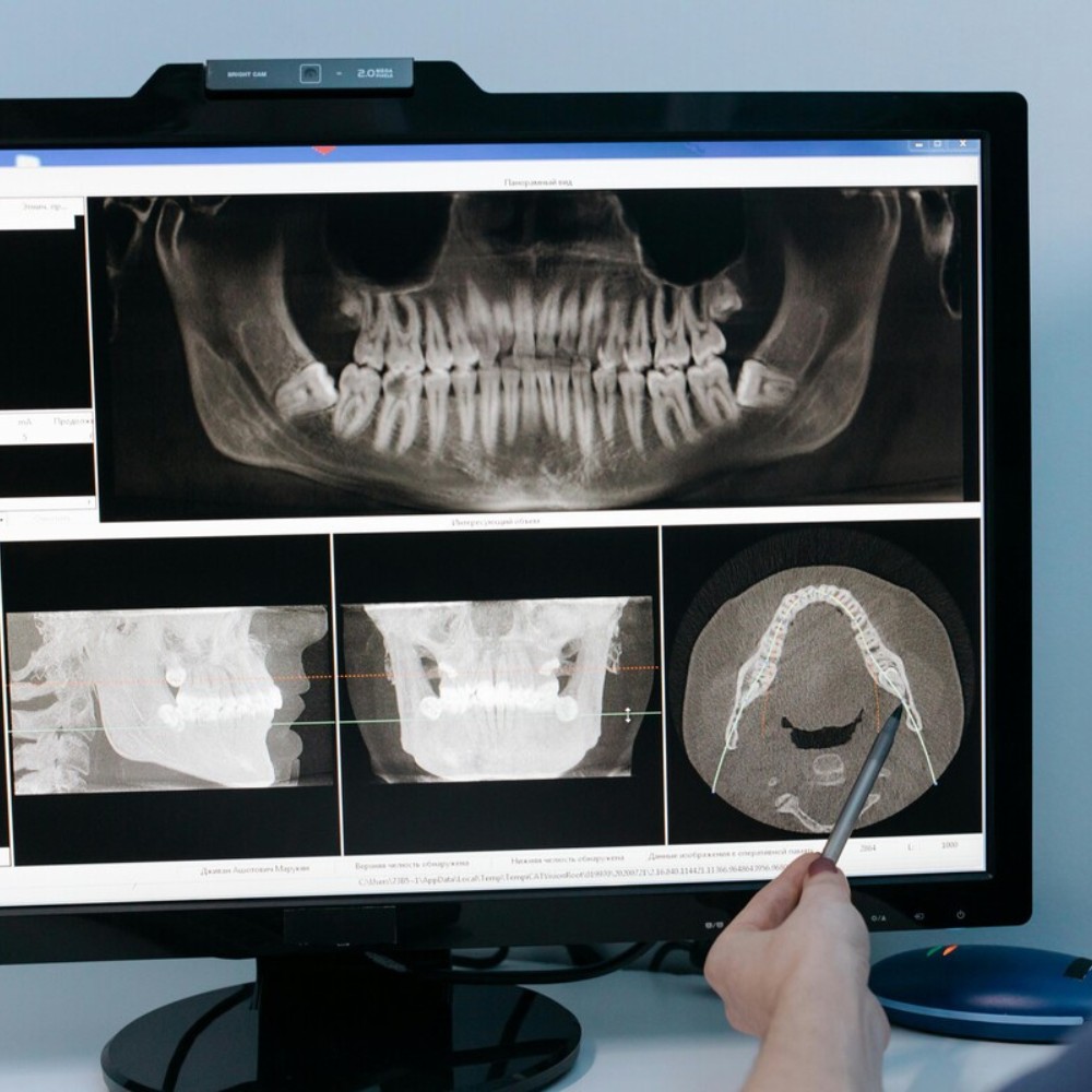 dentist reviewing dental x-ray to evaluate jawbone for implant placement