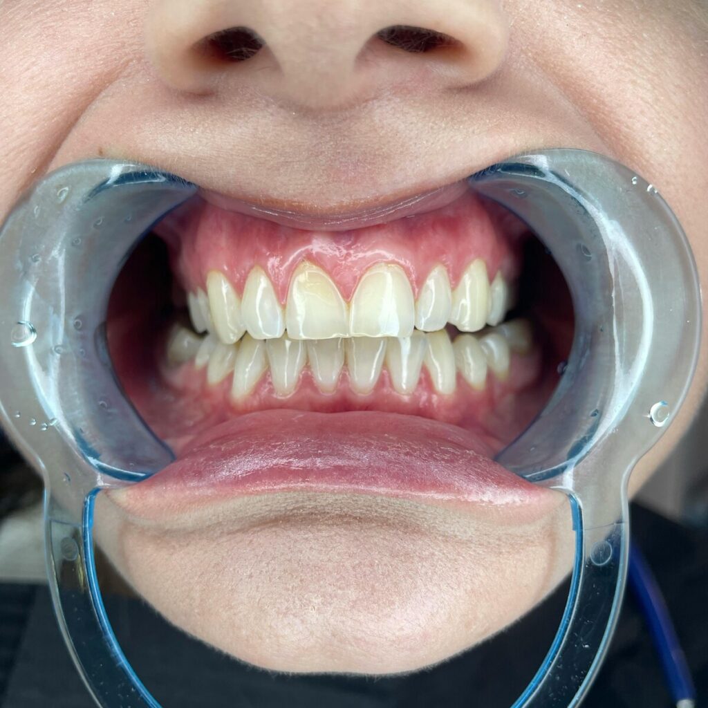 patient teeth and gums during dental exam showing gum health condition