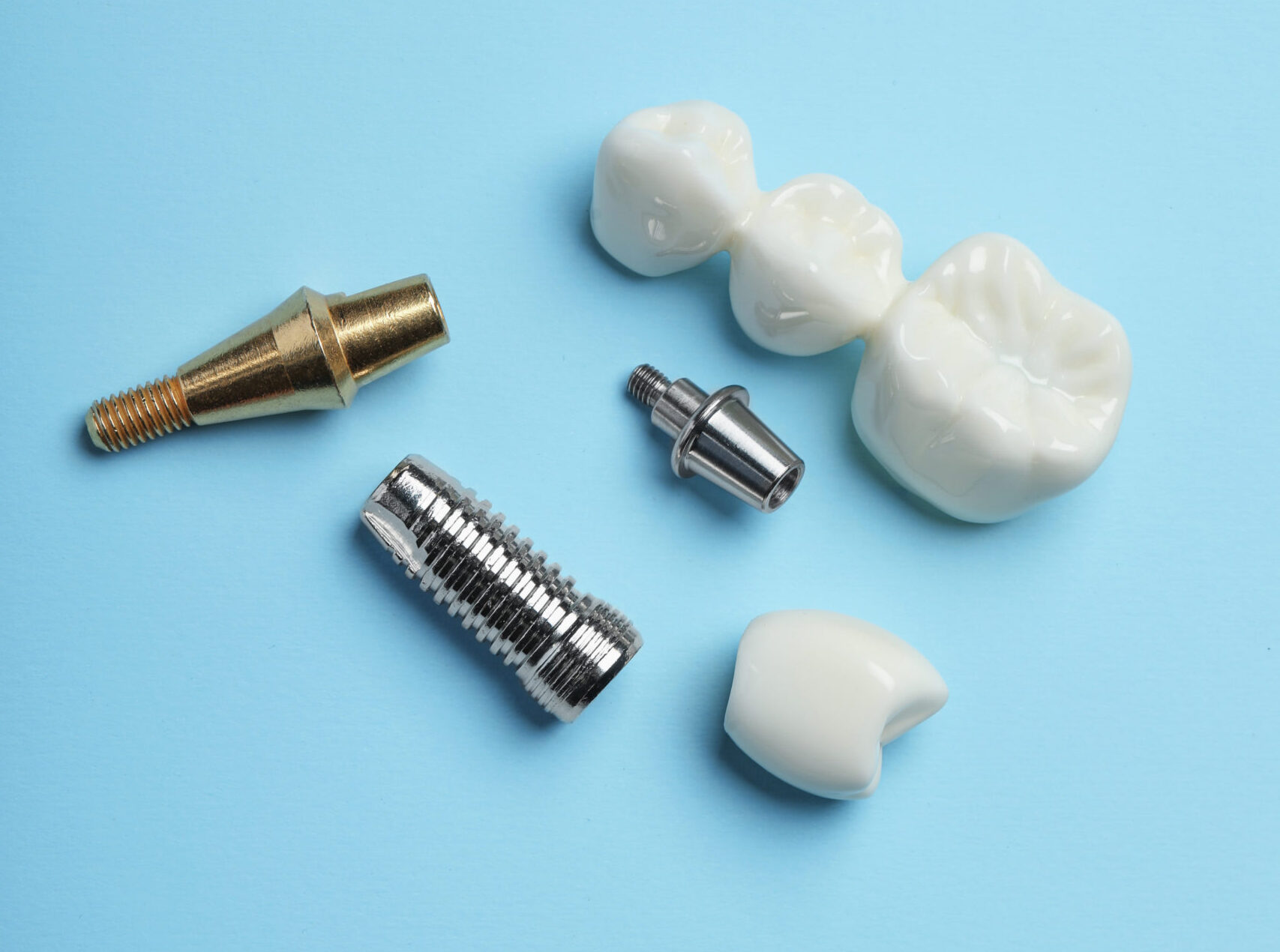 Featured image for “Dental Implants vs Dental Bridges”