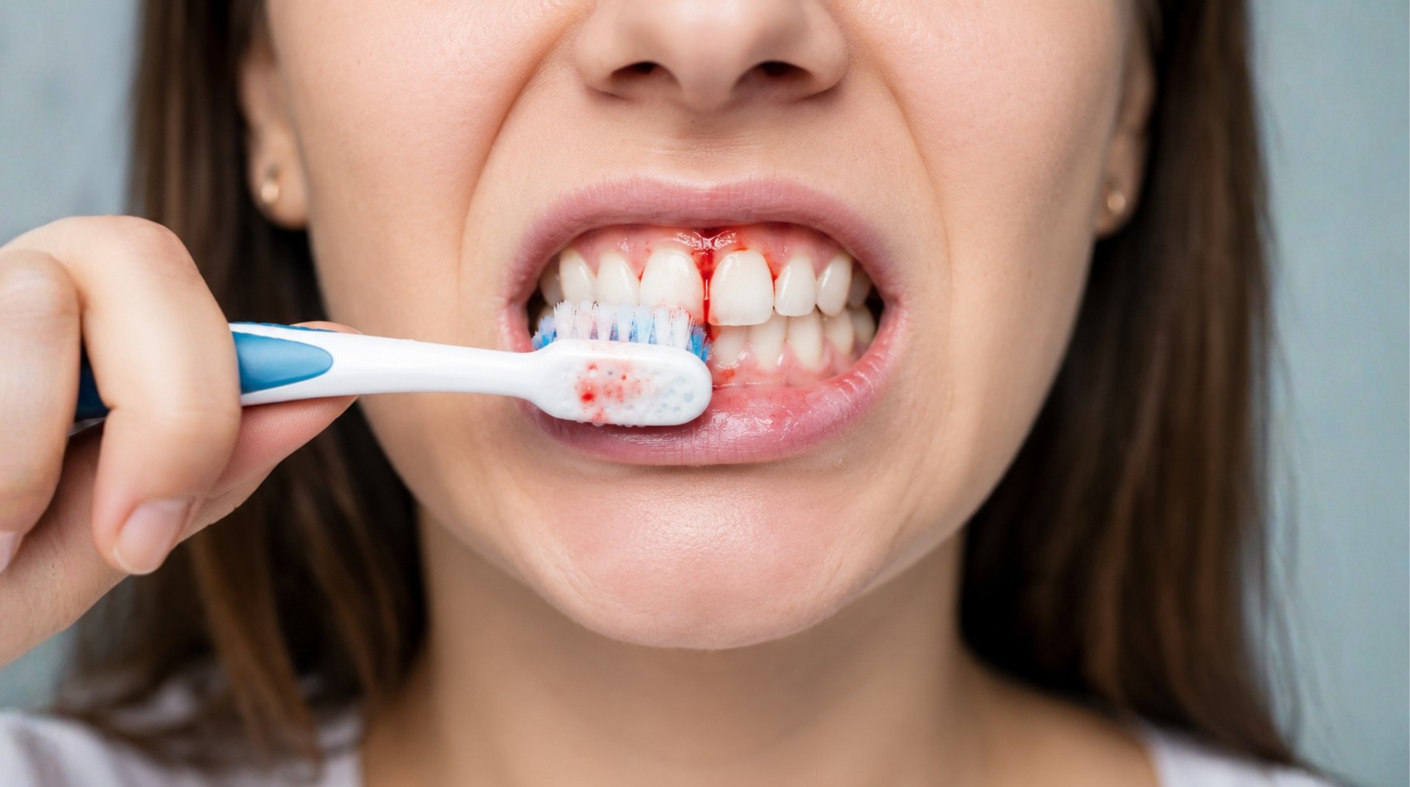 Featured image for “Bleeding Gums Before Cosmetic Work”